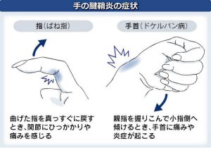 取手市くまもと整骨院　手の腱鞘炎の症状